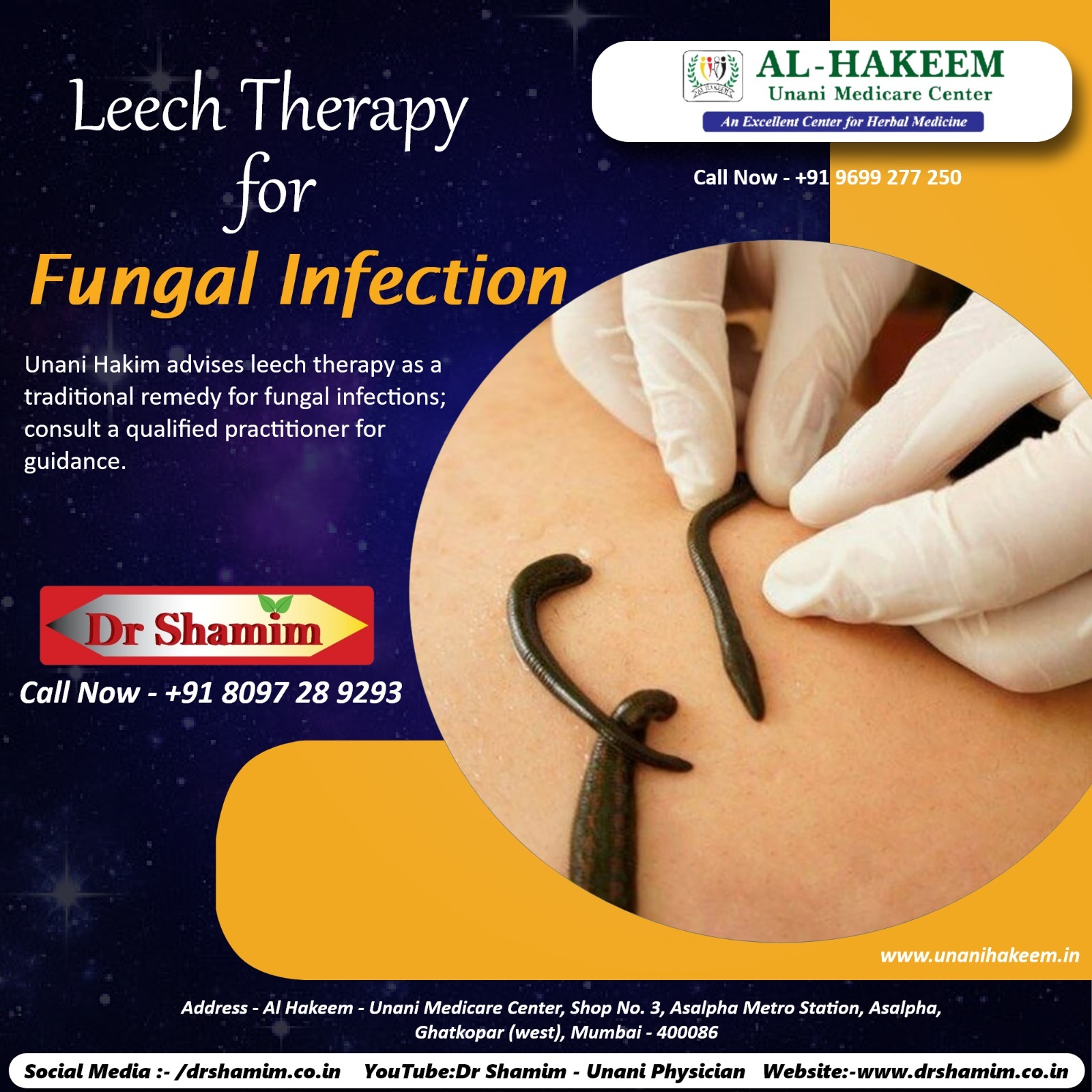 Leech Theraphy for fungal infection.