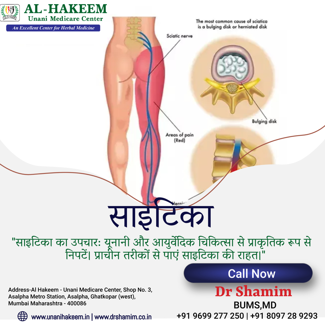 "साइटिका का उपचारः यूनानी और आयुर्वेदिक चिकित्सा से प्राकृतिक रूप से निपटें। प्राचीन तरीकों से पाएं साइटिका की राहत।"