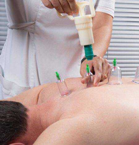 Cupping Therapy - Hijama by Dr Shamim
